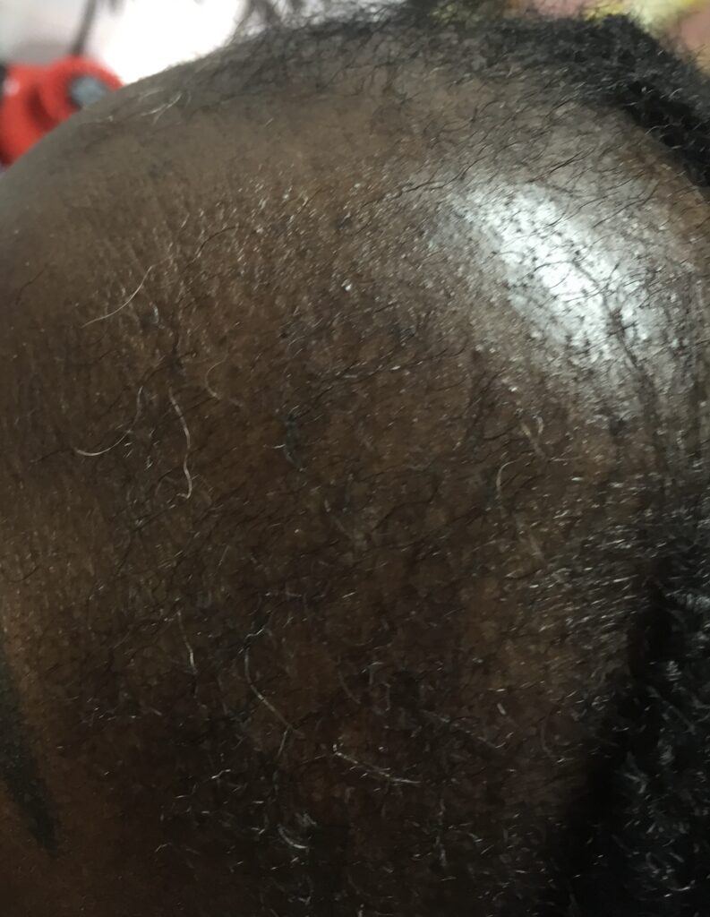 hair loss from Diffuse aAopecial