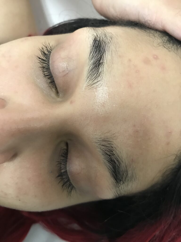 Improvement in eyebrow after procedure
